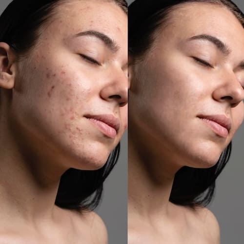 Вакуумний очищувач шкіри і пор MEDICA+ SKINCLEANER 9.0 BL (Японія)