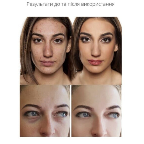 НАБІР: ВАКУУМНИЙ ОЧИСНИК ШКІРИ І ПОР MEDICA + SCINCLEAN 9.0 BL ( ЯПОНІЯ ) + ІНСТРУМЕНТИ ДЛЯ ЧИСТКИ ОБЛИЧЧЯ (EASYCLEAN)