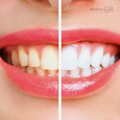 Гель для відбілювання MEDICA+ WhitePearl PenGel 3X (Японія)