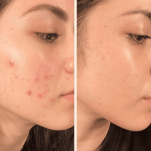 Портативний дарсонваль MEDICA+ DARSOLINE 7.0 + Суспензія Skin-Balancing