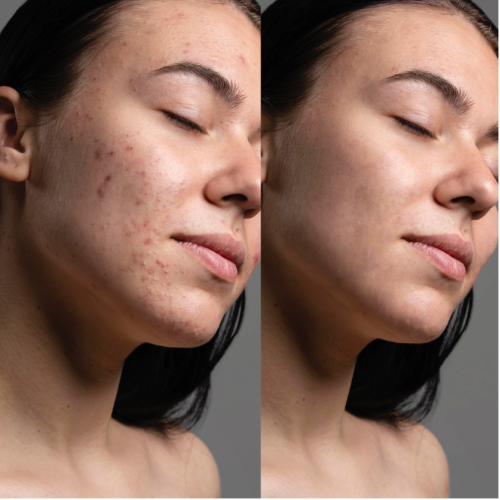 Вакуумний очищувач шкіри і пор MEDICA+ SKINCLEANER 9.0 WT (Японія)