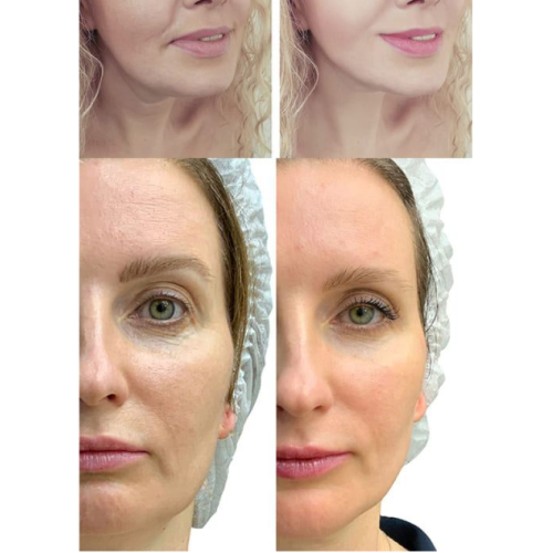 МІКРОСТРУМОВИЙ RF ЛІФТИНГ-МАСАЖЕР ДЛЯ ОБЛИЧЧЯ MEDICA+ SKIN LIFTING 7.0 PINK ЯПОНІЯ (EMS+LED)