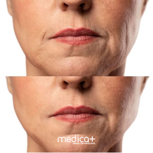 МІКРОСТРУМОВИЙ RF ЛІФТИНГ-МАСАЖЕР ДЛЯ ОБЛИЧЧЯ MEDICA+ SKIN LIFTING 7.0 PINK ЯПОНІЯ (EMS+LED)